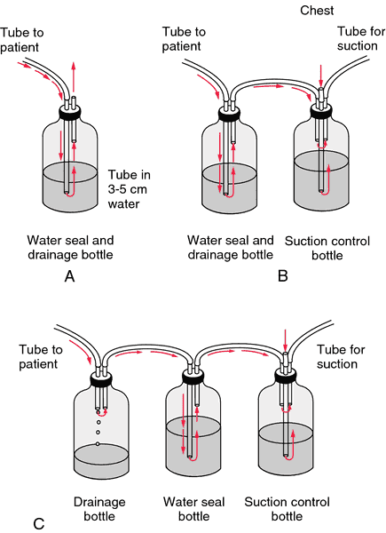 Medicine & Physics -- Question About Chest Tube Suction Techniques